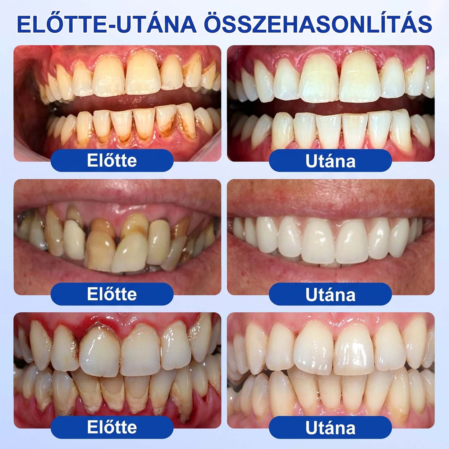Evolvion® 🦷 GumRevive Ínyregeneráló Gél – Az egészségesebb ínyért és magabiztosabb mosolyért 👍