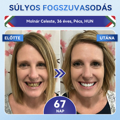 🦷 𝐆𝐥𝐢𝐦𝐦𝐞𝐫𝐥𝐲® 𝐓𝐢𝐝𝐞𝐠𝐥𝐮𝐬𝐢𝐛 𝐅𝐨𝐠- é𝐬 Í𝐧𝐲𝐫𝐞𝐠𝐞𝐧𝐞𝐫á𝐥ó 𝐌𝐢𝐤𝐫𝐨𝐭ű𝐬 𝐏á𝐫𝐧𝐚 | 𝐅𝐞𝐣𝐥𝐞𝐭𝐭 Ő𝐬𝐬𝐞𝐣𝐭𝐞𝐬 𝐀𝐤𝐭𝐢𝐯á𝐥á𝐬 𝐅𝐨𝐠𝐟𝐞𝐡é𝐫í𝐭ő 𝐂𝐬í𝐤𝐨𝐤 (🦷 𝐅𝐨𝐠𝐳𝐨𝐦á𝐧𝐜 é𝐬 𝐃𝐞𝐧𝐭𝐢𝐧 Ú𝐣𝐫𝐚é𝐩í𝐭é𝐬𝐞 • Í𝐧𝐲𝐞𝐫ő𝐬í𝐭é𝐬 • 𝐅𝐨𝐠𝐚𝐭𝐥𝐚𝐧𝐨𝐝á𝐬 é𝐬 𝐒𝐳𝐚𝐠𝐞𝐥𝐭á𝐯𝐨𝐥í𝐭á𝐬 • 𝐅𝐨𝐠é𝐫𝐳é𝐤𝐞𝐧𝐲𝐬é𝐠 𝐌𝐞𝐠á𝐥𝐥í𝐭á𝐬𝐚)🦷