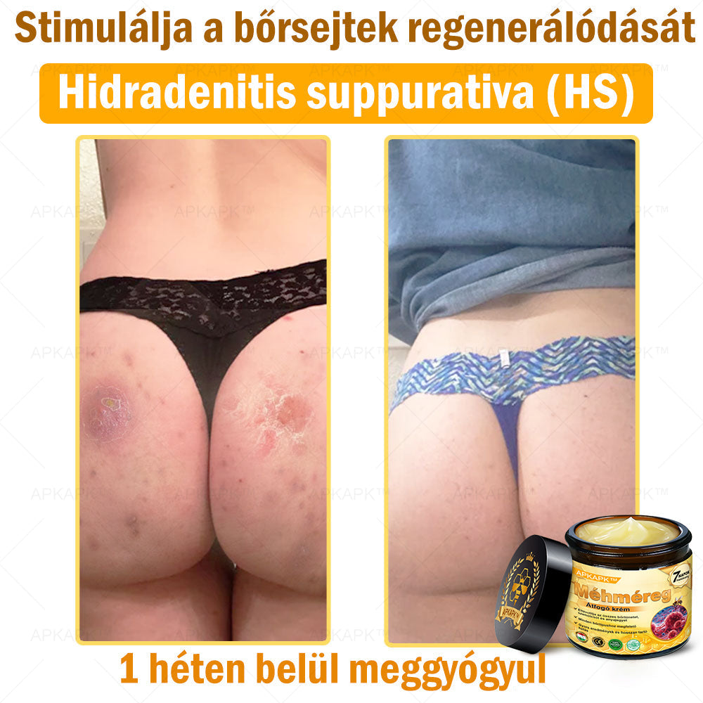 𝐀𝐏𝐊𝐀𝐏𝐊® 𝐌é𝐡𝐦é𝐫𝐞𝐠 Á𝐭𝐟𝐨𝐠ó 𝐤𝐫é𝐦 (🐝𝐬𝐞𝐠í𝐭 𝐦𝐞𝐠𝐨𝐥𝐝𝐚𝐧𝐢 𝐚𝐳 𝐚𝐥á𝐛𝐛𝐢 𝐛ő𝐫𝐩𝐫𝐨𝐛𝐥é𝐦á𝐤𝐚𝐭: 𝐫á𝐧𝐜𝐨𝐤, 𝐡𝐞𝐠𝐞𝐤, 𝐩𝐢𝐠𝐦𝐞𝐧𝐭𝐟𝐨𝐥𝐭𝐨𝐤, 𝐬𝐭𝐫𝐢á𝐤, 𝐩𝐚𝐭𝐭𝐚𝐧á𝐬𝐨𝐤, 𝐩𝐢𝐤𝐤𝐞𝐥𝐲𝐬ö𝐦ö𝐫, 𝐞𝐤𝐜é𝐦𝐚, 𝐛ő𝐫𝐞𝐥𝐯á𝐥𝐭𝐨𝐳á𝐬𝐨𝐤, 𝐢𝐫𝐫𝐢𝐭á𝐜𝐢ó𝐤, 𝐠𝐲𝐮𝐥𝐥𝐚𝐝á𝐬𝐨𝐤 é𝐬 𝐞𝐠𝐲é𝐛 𝐛ő𝐫𝐩𝐚𝐧𝐚𝐬𝐳𝐨𝐤)🔥